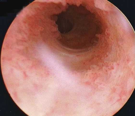 View up a urethra, from a cystoscope.