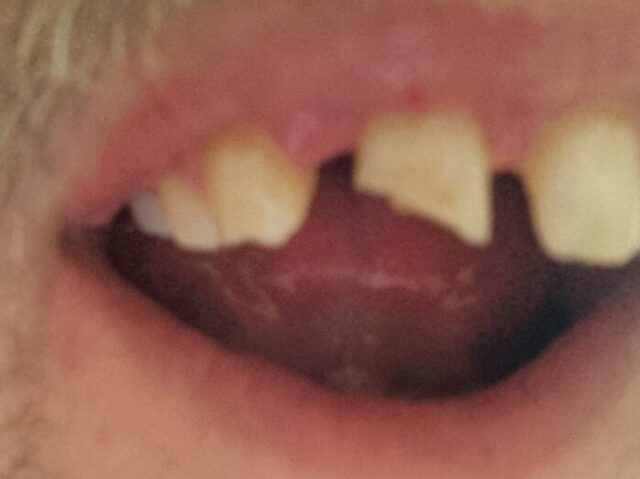 Close-up f Dan's mouth showing a shattered front tooth.