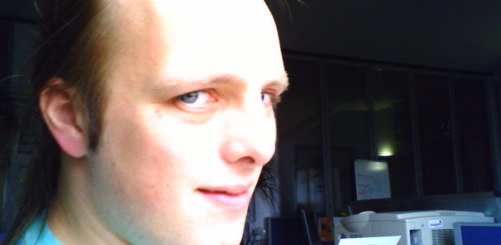 Image representing post: It’s True: I’ve Got Baldness-Of-The-Chin