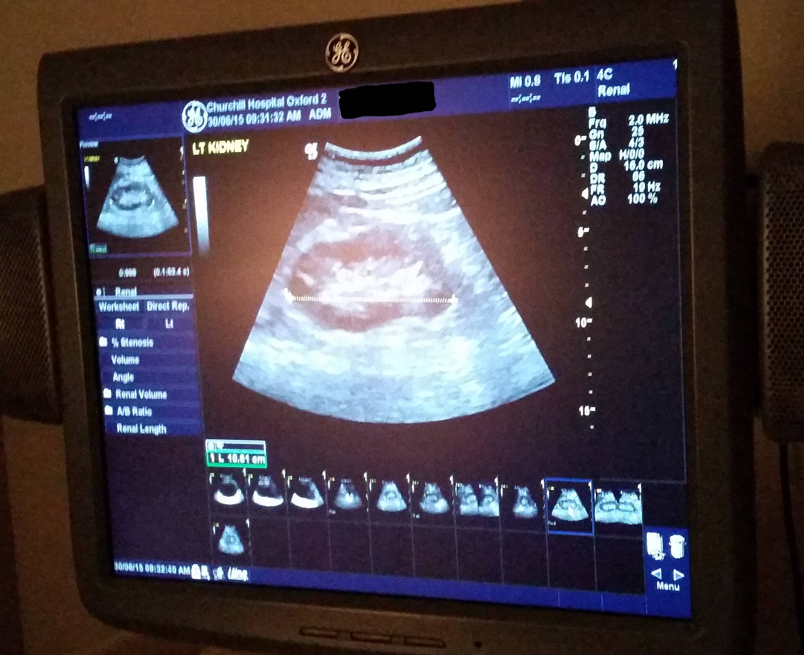 Dan's left kidney