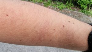 Arm with scratches