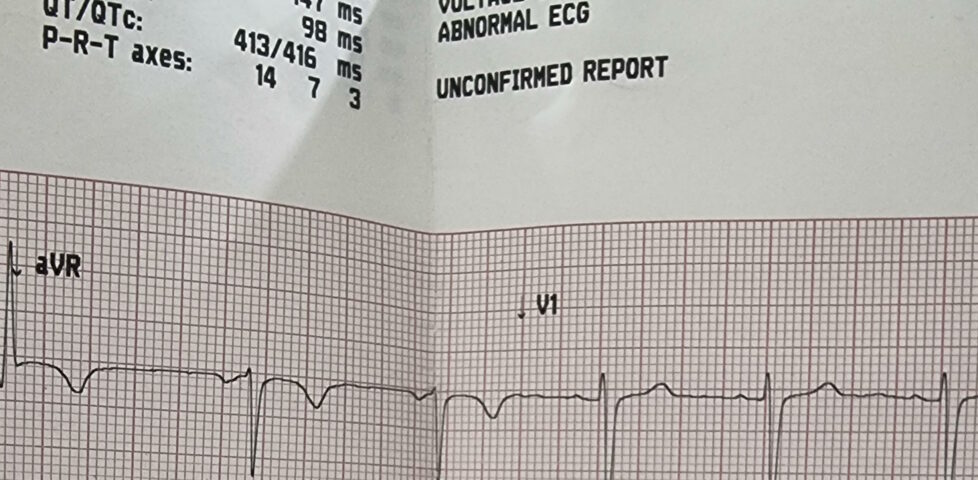 ECG printout showing a report of "Abnormal ECG: sinus arrhythmia".