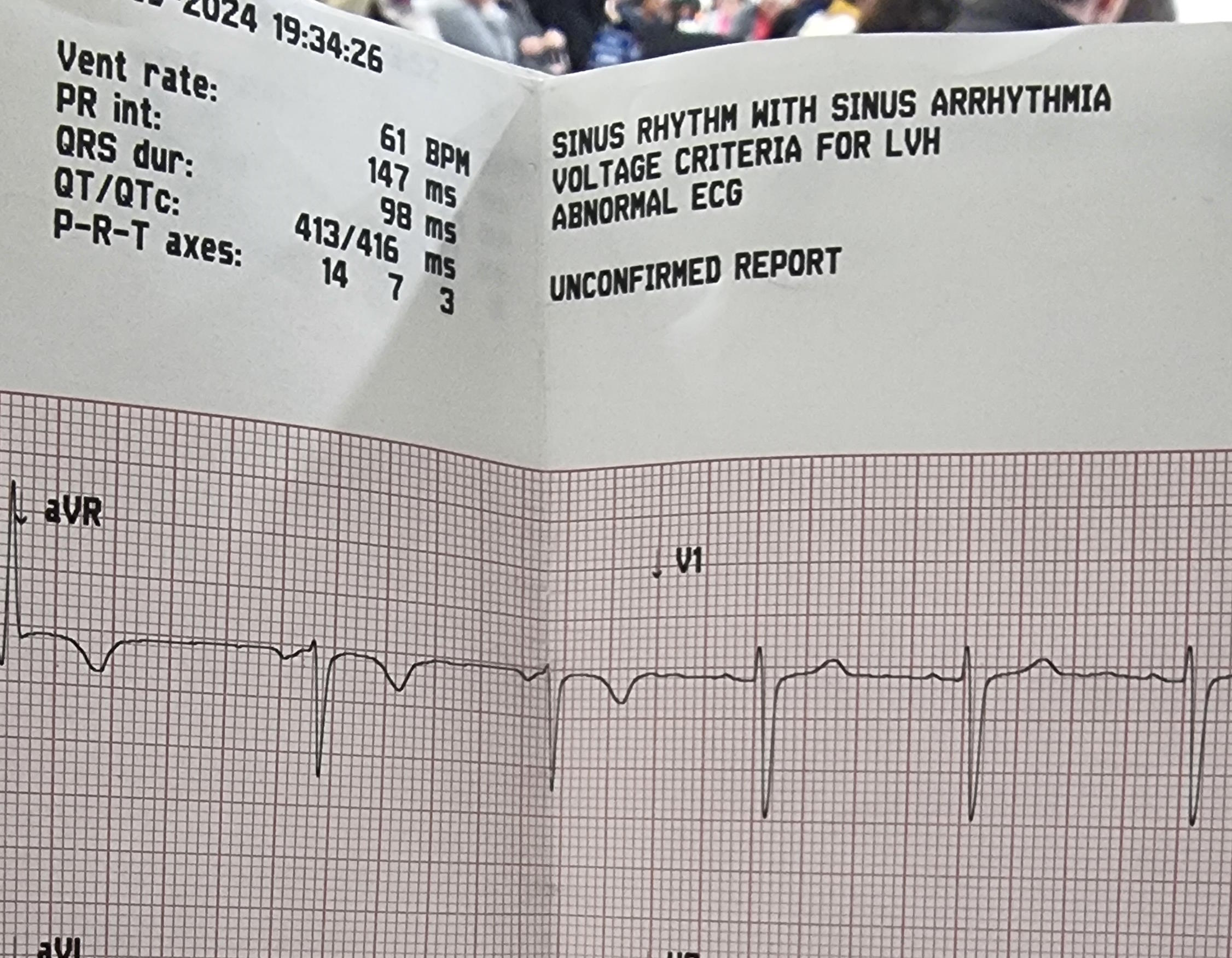 Full image of ECG printout showing a report of "Abnormal ECG: sinus arrhythmia".