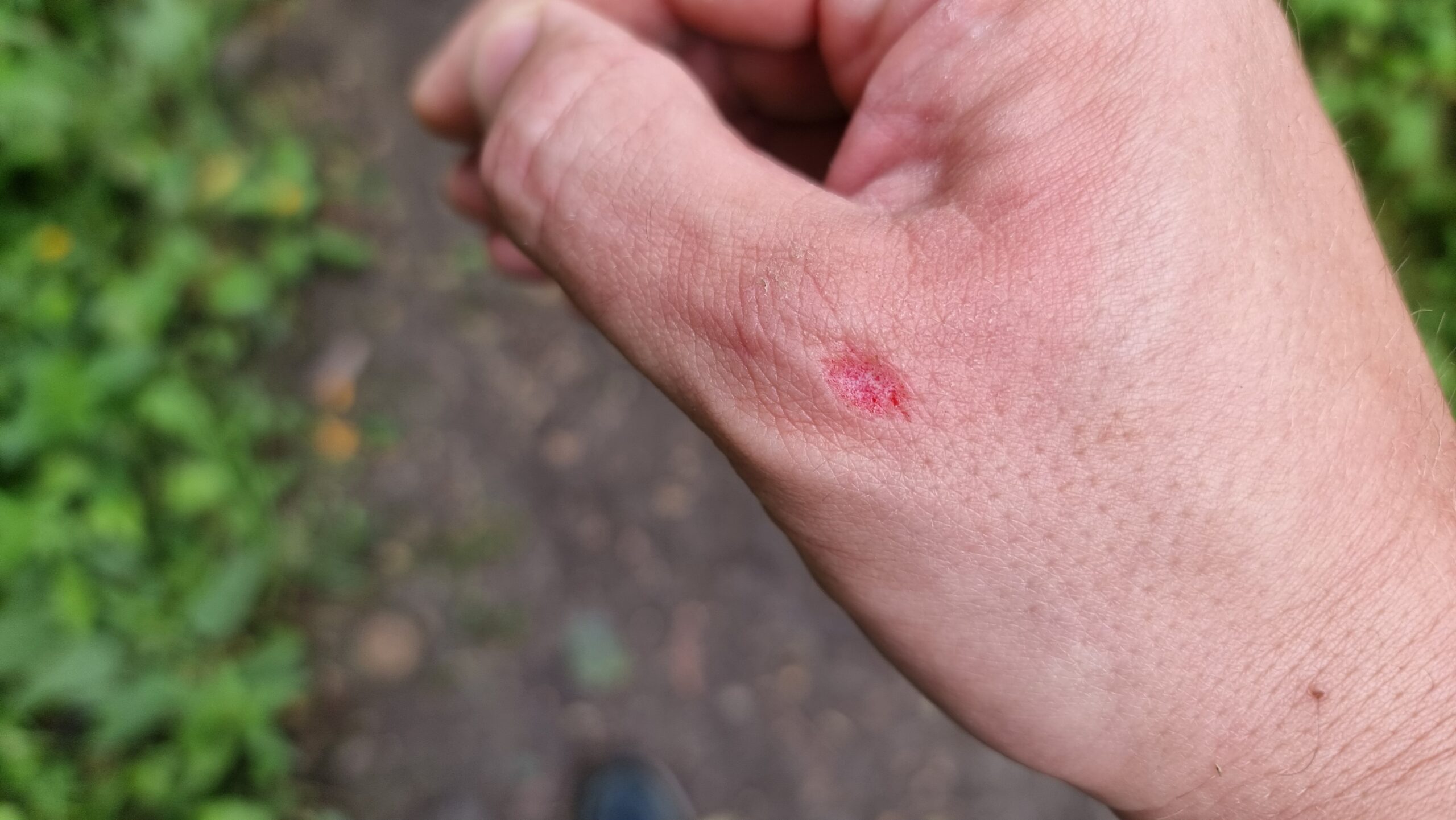 Full image of A hand with a small chunk torn out of the back of the thumb, exposing bright red flesh beneath.