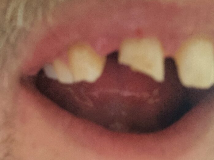 Full image of Close-up f Dan's mouth showing a shattered front tooth.